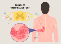 zoster paralysis