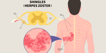 zoster paralysis