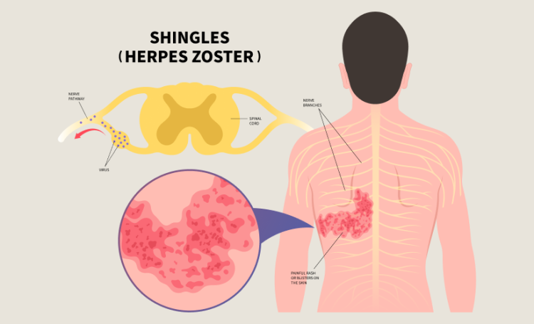 zoster paralysis