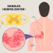 zoster paralysis
